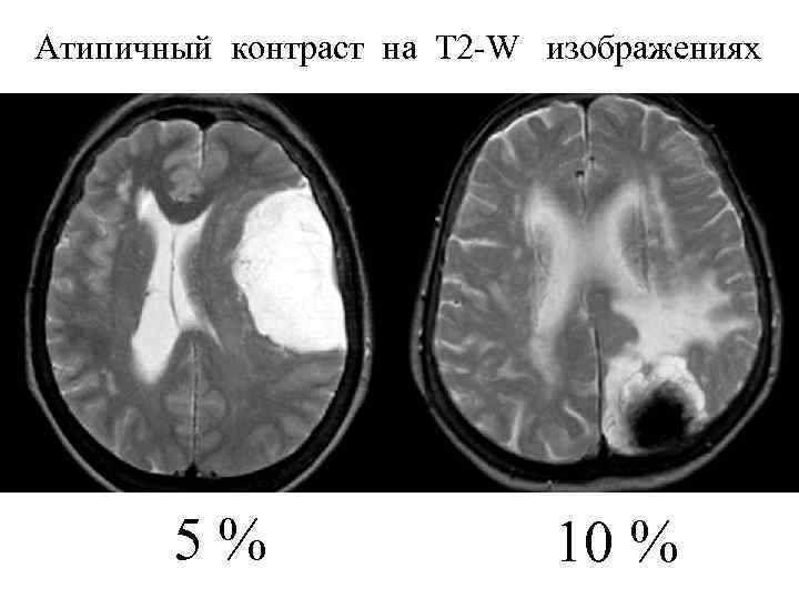 Атипичный контраст на Т 2 -W изображениях 5% 10 % 