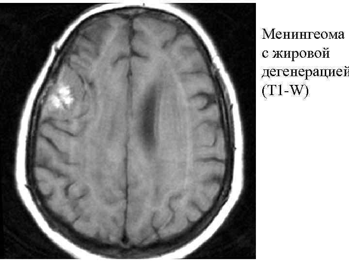 Менингеома с жировой дегенерацией (T 1 -W) 
