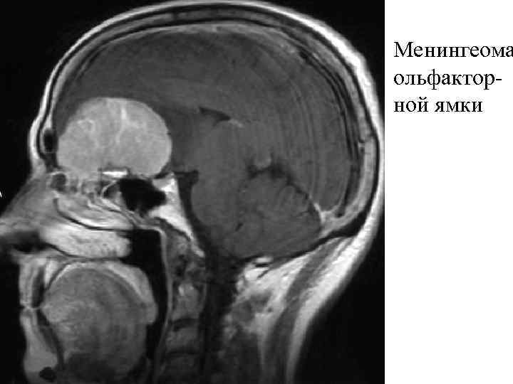 Менингиома головного мозга - причины, симптомы, …