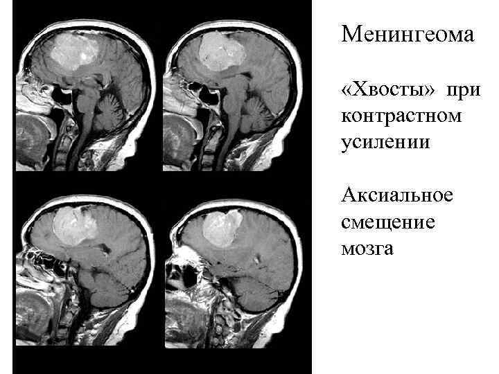 Менингеома «Хвосты» при контрастном усилении Аксиальное смещение мозга 