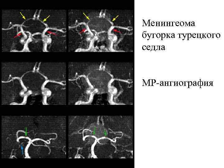 Менингеома бугорка турецкого седла МР-ангиография 