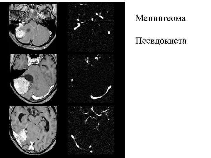Менингеома Псевдокиста 
