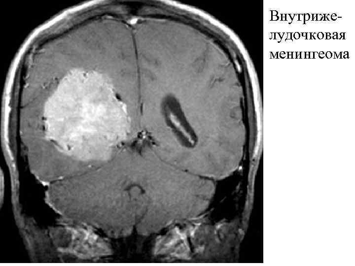 Внутрижелудочковая менингеома 