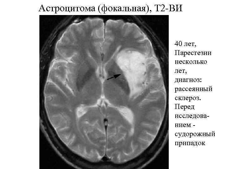 Астроцитома головного мозга прогноз. Анапластическая астроцитома кт. Глиальная астроцитома. Астроцитома головного мозга кт. Астроцитома доброкачественная.