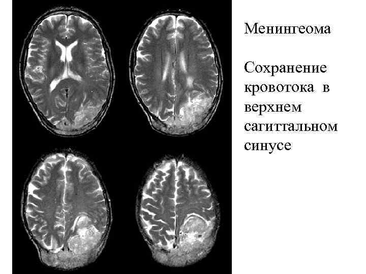 Менингеома Сохранение кровотока в верхнем сагиттальном синусе 