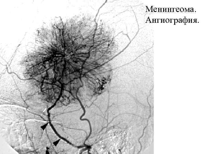 Менингеома. Ангиография. 