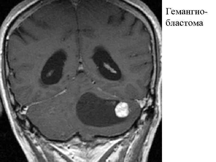 Гемангиобластома 
