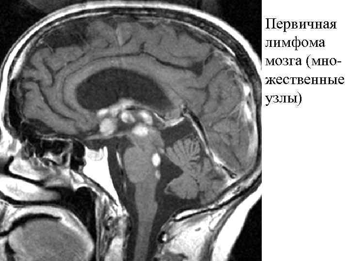 Первичная лимфома мозга (множественные узлы) 