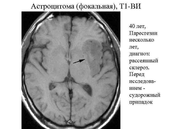 Астроцитома (фокальная), Т 1 -ВИ 40 лет, Парестезии несколько лет, диагноз: рассеянный склероз. Перед