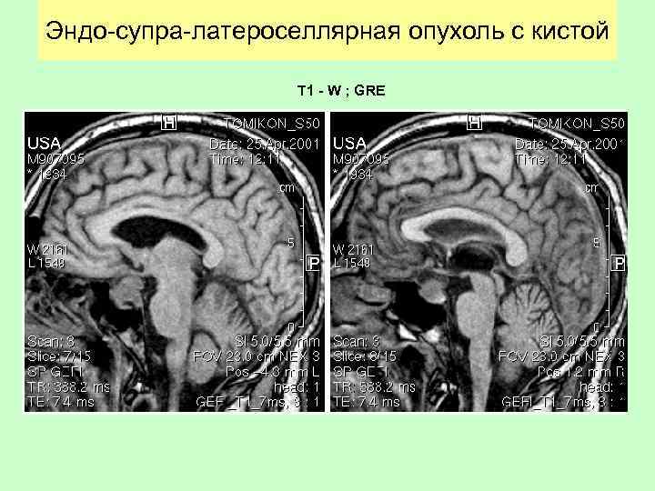 Глиальная опухоль головного. Фибриллярная астроцитома патанатомия. Глиальная опухоль головного мозга кт. Эндоселлярные опухоли.