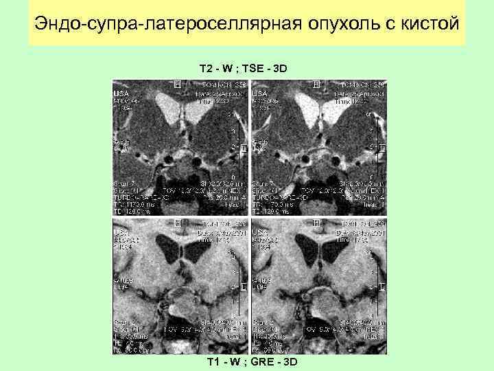 Эндо-супра-латероселлярная опухоль с кистой T 2 - W ; TSE - 3 D T