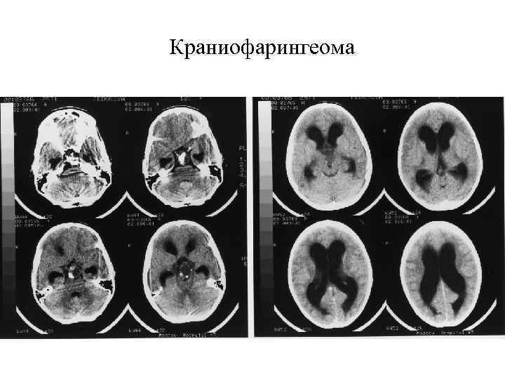 Краниофарингеома 
