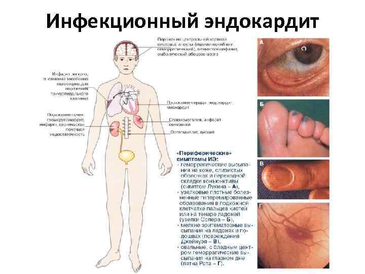 Инфекционный эндокардит 