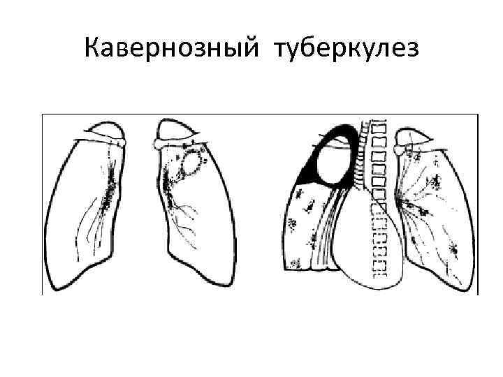 Кавернозный туберкулез 