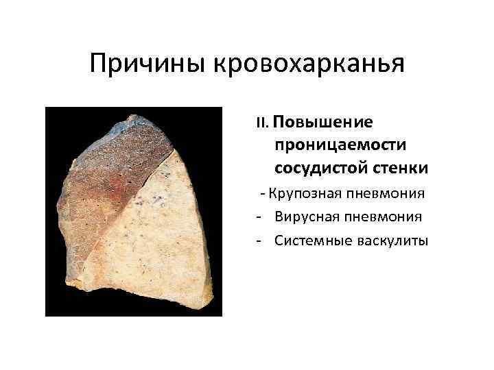 Причины кровохарканья II. Повышение проницаемости сосудистой стенки - Крупозная пневмония - Вирусная пневмония -