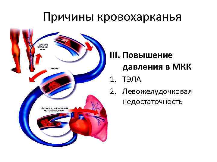 Причины кровохарканья III. Повышение давления в МКК 1. ТЭЛА 2. Левожелудочковая недостаточность 