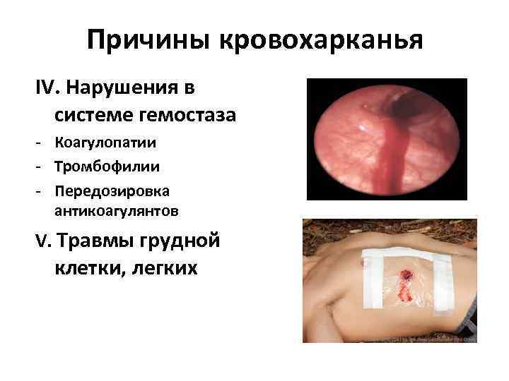 Причины кровохарканья IV. Нарушения в системе гемостаза - Коагулопатии - Тромбофилии - Передозировка антикоагулянтов