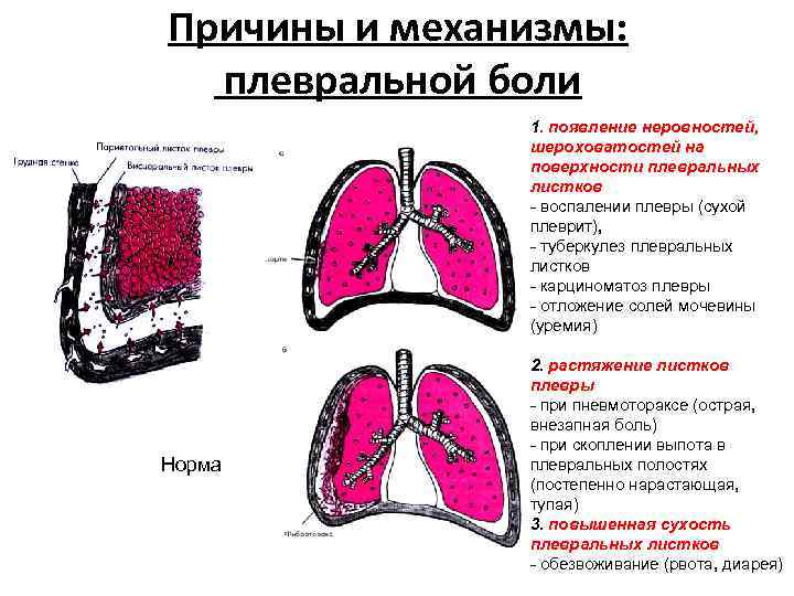 Причины и механизмы: плевральной боли 1. появление неровностей, шероховатостей на поверхности плевральных листков -