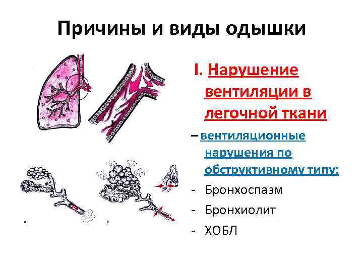 Причины и виды одышки I. Нарушение вентиляции в легочной ткани – вентиляционные нарушения по