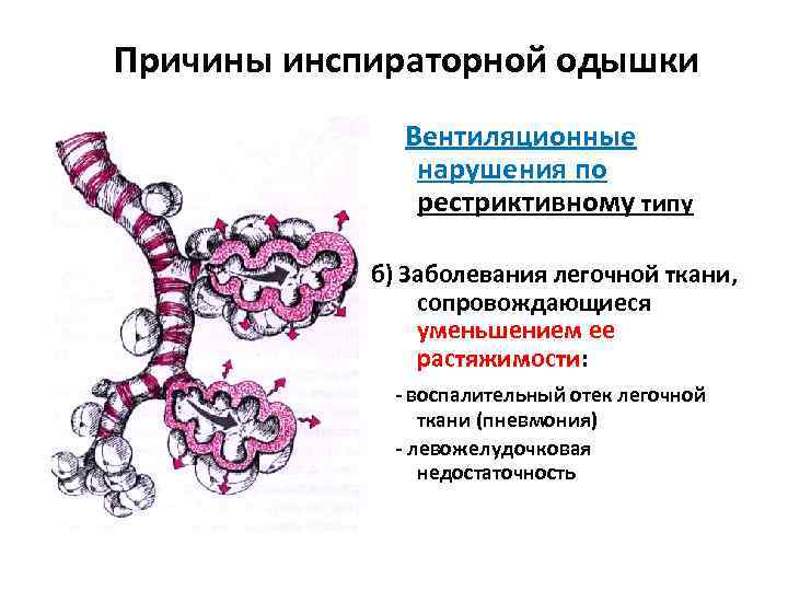 Причины инспираторной одышки Вентиляционные нарушения по рестриктивному типу б) Заболевания легочной ткани, сопровождающиеся уменьшением