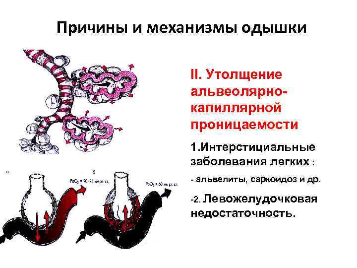 Причины и механизмы одышки II. Утолщение альвеолярнокапиллярной проницаемости 1. Интерстициальные заболевания легких : -