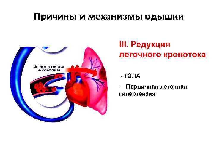 Причины и механизмы одышки III. Редукция легочного кровотока - ТЭЛА - Первичная легочная гипертензия
