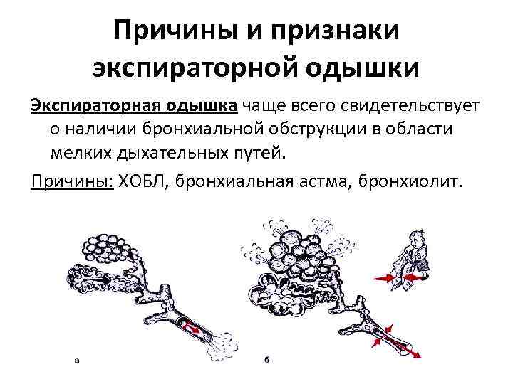 Причины и признаки экспираторной одышки Экспираторная одышка чаще всего свидетельствует о наличии бронхиальной обструкции