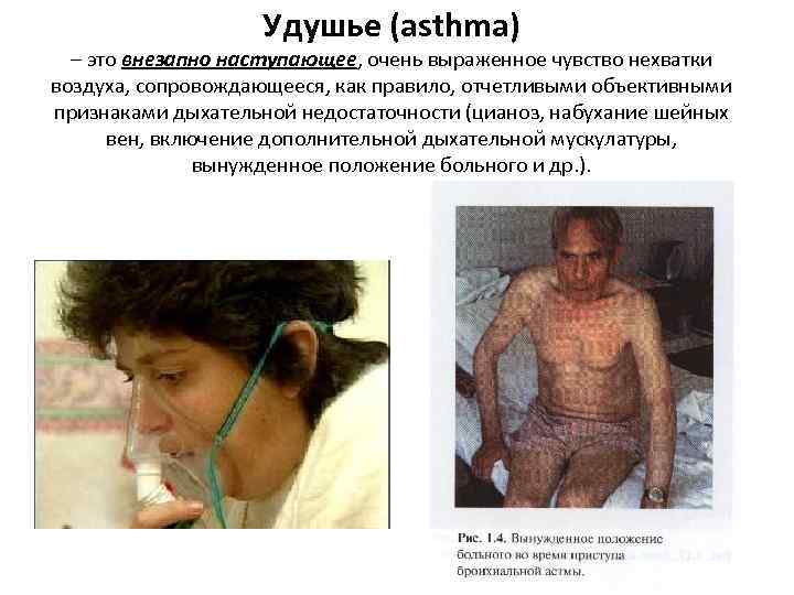 Удушье (asthma) – это внезапно наступающее, очень выраженное чувство нехватки воздуха, сопровождающееся, как правило,