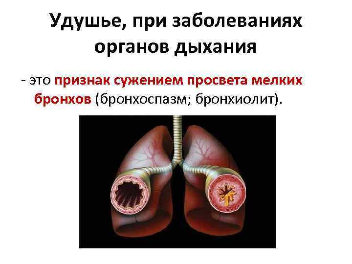 Удушье, при заболеваниях органов дыхания - это признак сужением просвета мелких бронхов (бронхоспазм; бронхиолит).