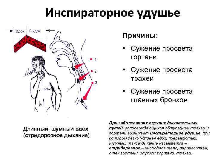 Инспираторное удушье Причины: • Сужение просвета гортани • Сужение просвета трахеи • Сужение просвета