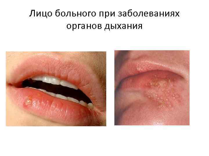 Лицо больного при заболеваниях органов дыхания 