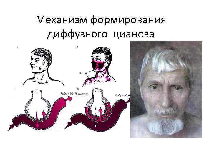 Механизм формирования диффузного цианоза 