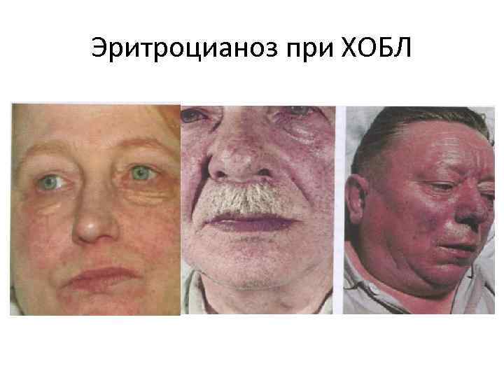 Эритроцианоз при ХОБЛ 