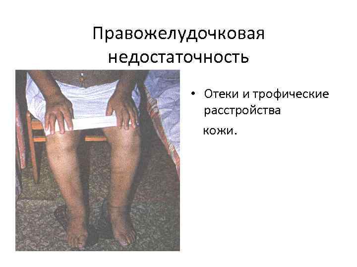 Правожелудочковая недостаточность • Отеки и трофические расстройства кожи. 