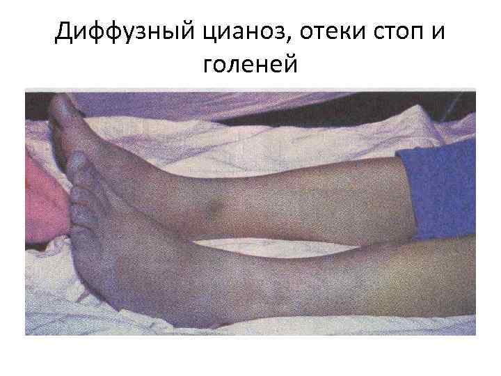 Диффузный цианоз, отеки стоп и голеней 
