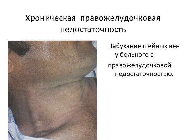 Хроническая правожелудочковая недостаточность Набухание шейных вен у больного с правожелудочковой недостаточностью. 