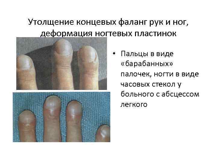 Утолщение концевых фаланг рук и ног, деформация ногтевых пластинок • Пальцы в виде «барабанных»