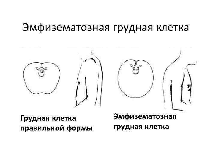 Патологические формы грудной клетки презентация