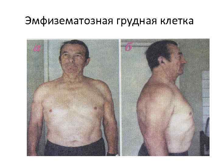 Эмфизематозная грудная клетка 