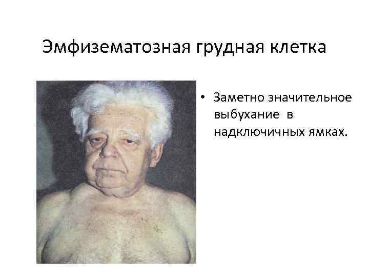 Эмфизематозная грудная клетка • Заметно значительное выбухание в надключичных ямках. 