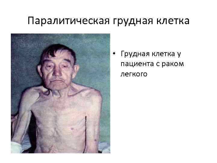 Паралитическая грудная клетка • Грудная клетка у пациента с раком легкого 
