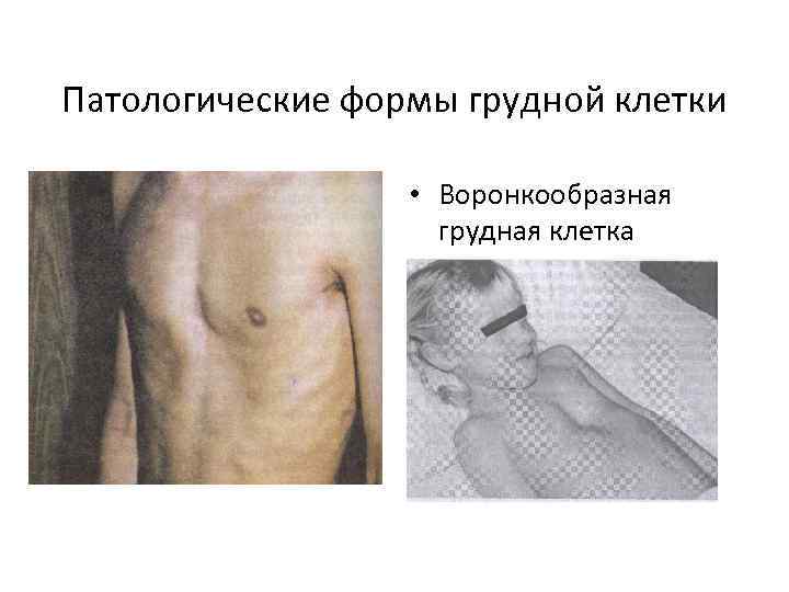 Патологические формы грудной клетки • Воронкообразная грудная клетка 