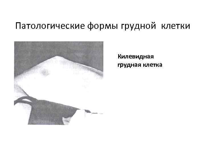 Патологические формы грудной клетки Килевидная грудная клетка 