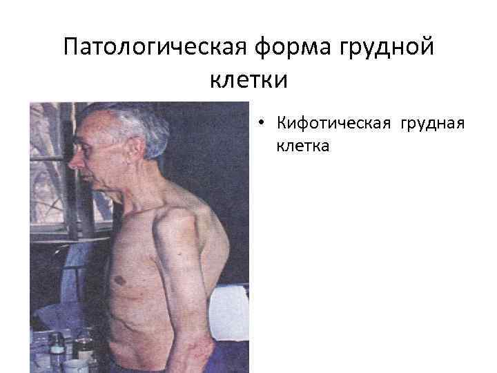 Патологическая форма грудной клетки • Кифотическая грудная клетка 