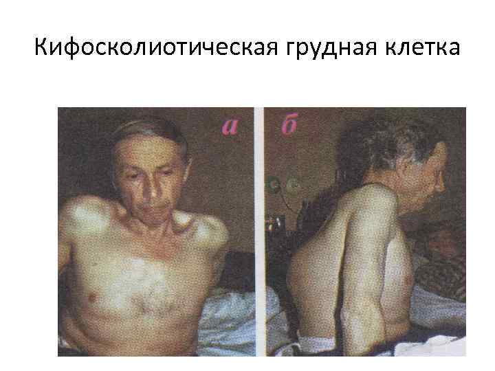 Кифосколиотическая грудная клетка 