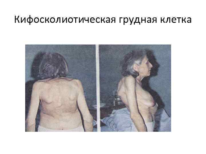 Кифосколиотическая грудная клетка 