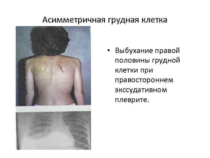 Асимметричная грудная клетка • Выбухание правой половины грудной клетки правостороннем экссудативном плеврите. 