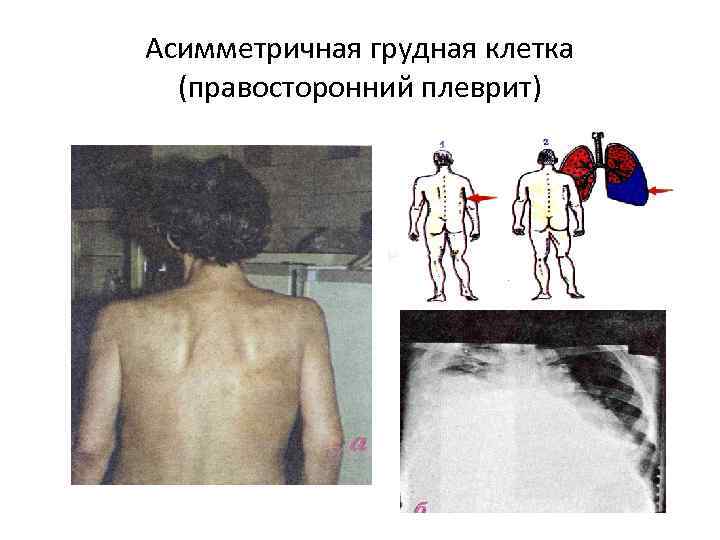 Асимметричная грудная клетка (правосторонний плеврит) 