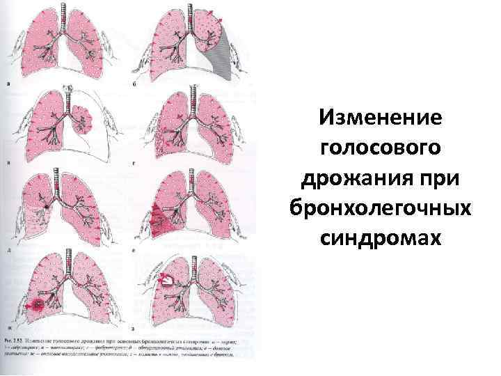 Изменение голосового дрожания при бронхолегочных синдромах 