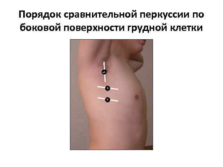 Порядок сравнительной перкуссии по боковой поверхности грудной клетки 1 2 3 